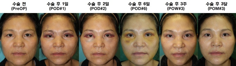 55세 여성, 이중평면 안면거상(55/F, Dual-plane full facelift) 관련 이미지 64