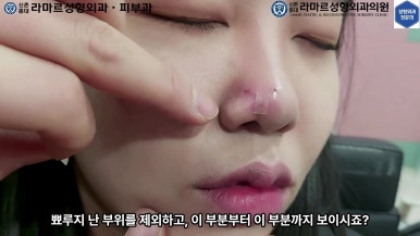 21세 여성 코 지름 1cm 점 제거수술 : 나선피판술(Spiral Flap) 수술전~5달 경과. (+쌍꺼풀수술, 코필러) 관련 이미지 65