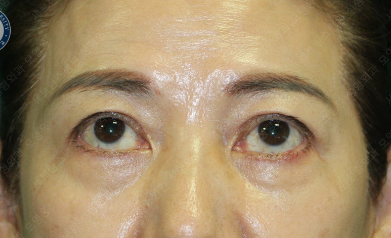 59세 여성, 그레이브스 안병증이 있는 돌출눈 중년 여성 하안검 성형술 (Lower blepharoplasty in Graves 관련 이미지 7