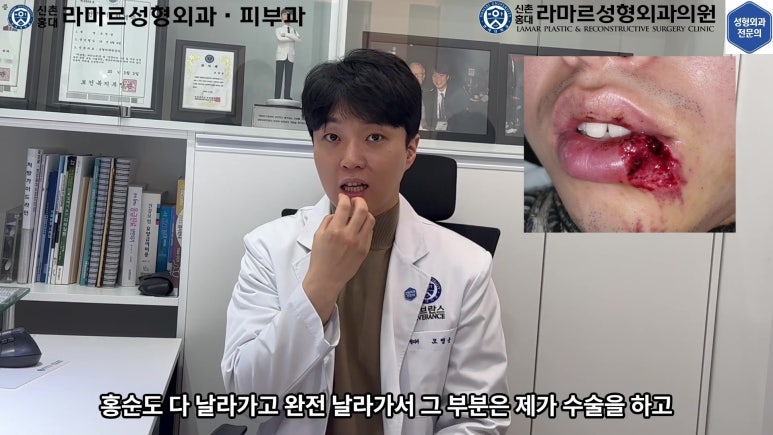 개에 물려 입술 1/3이 뜯긴 19세 남자분 치료 및 흉터 성형수술& 레이저 후기....! 관련 이미지 12