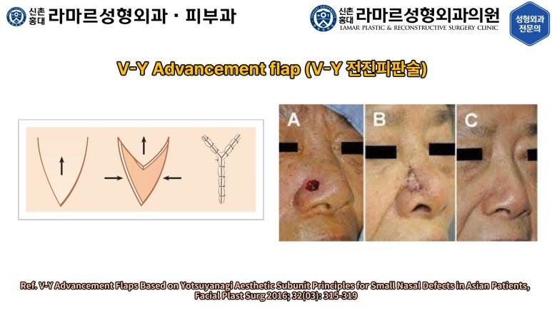 지름 1cm 코 점 제거수술 : 나선피판술(Spiral Flap) 수술전~1달 경과. (Feat. 턱끝필러+사각턱 보톡스) 관련 이미지 33