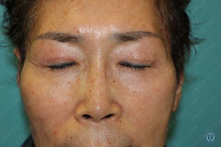 64세 여성 상안검성형술+눈매교정 (64/F Upper blepharoplasty with ptosis correction) 관련 이미지 28