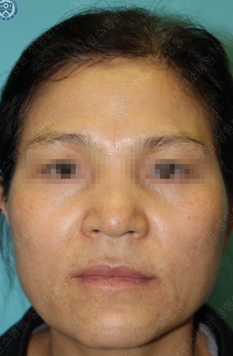 55세 여성, 이중평면 안면거상(55/F, Dual-plane full facelift) 관련 이미지 14