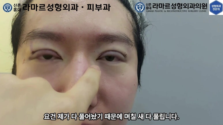 29세 남자, 소시지 쌍꺼풀 두줄따기로 낮추기 (쌍꺼풀 재수술) 관련 이미지 63