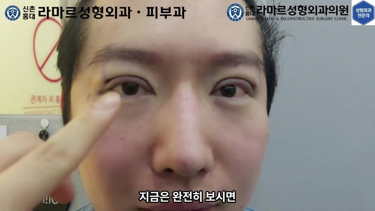29세 남자, 소시지 쌍꺼풀 두줄따기로 낮추기 (쌍꺼풀 재수술) 관련 이미지 59