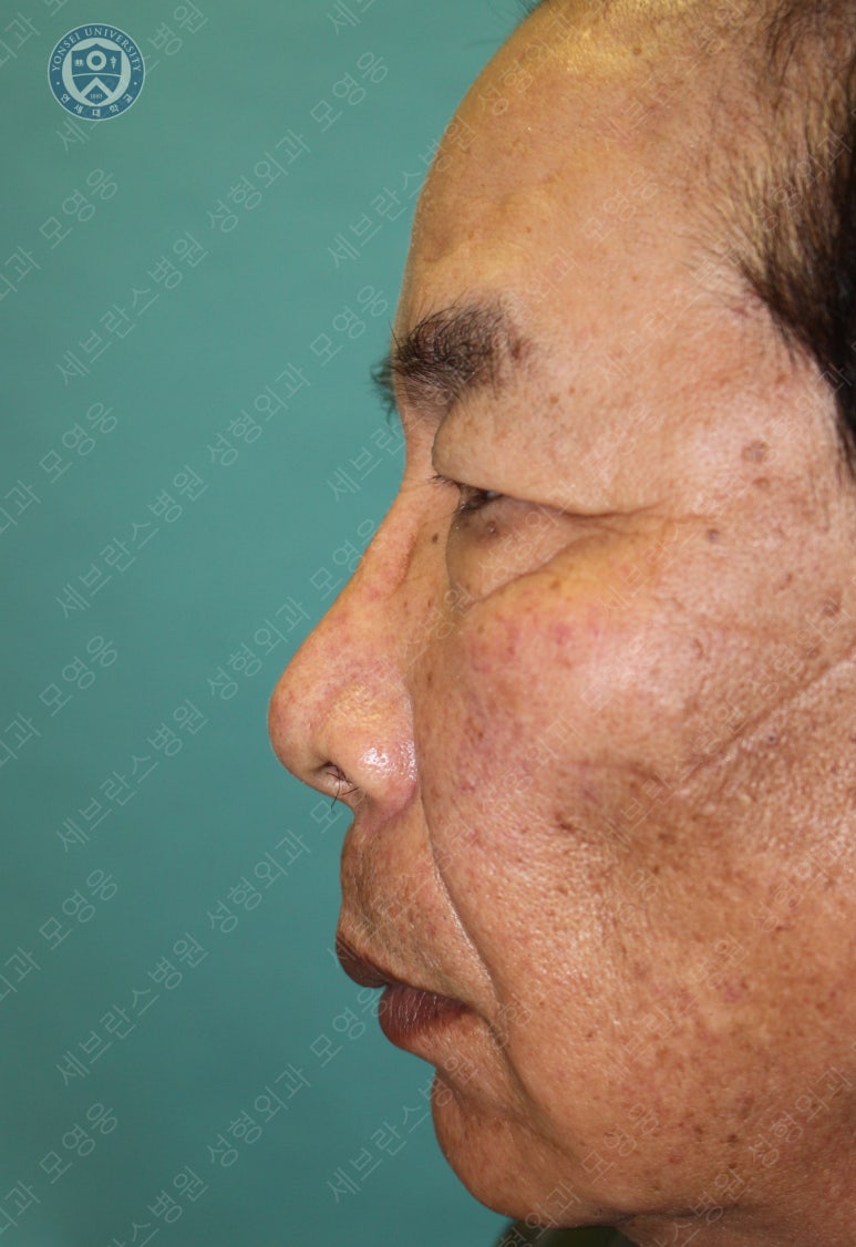 67세 남성, 상&middot;하안검성형술 및 안검하수교정 (67/M, Upper &  lower blepharoplasty with ptosis correction) 관련 이미지 4