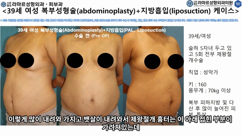 '복부성형술+지방흡입(Abdominoplasty+PAL)' 으로 뱃살 끝장내기! 관련 이미지 27