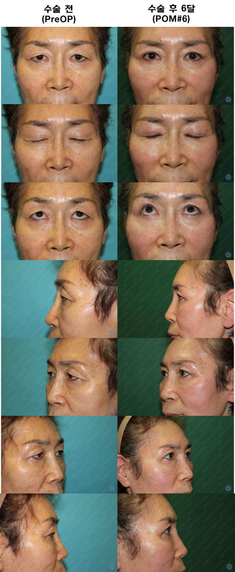 64세 여성 상안검성형술+눈매교정 (64/F Upper blepharoplasty with ptosis correction) 관련 이미지 43