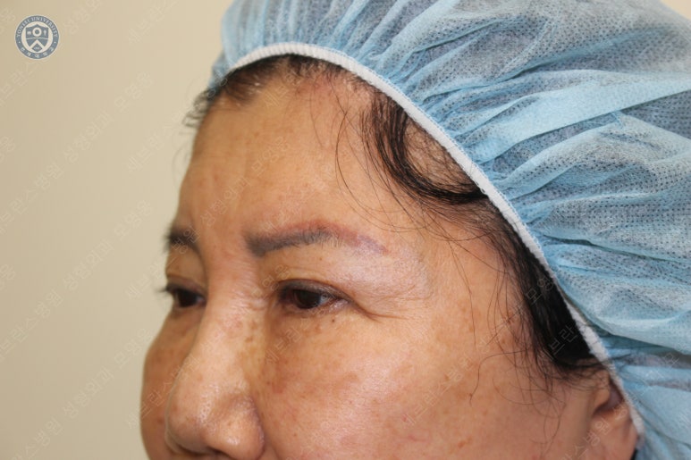 71세 여성, 이마거상술과 이마축소술 (71/F, Forehead lift and reduction) 관련 이미지 15