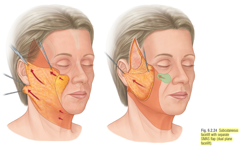 55세 여성, 이중평면 안면거상(55/F, Dual-plane full facelift) 관련 이미지 16