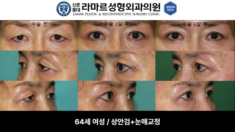 40대~80대 눈 수술 케이스 : 상안검성형술 전후 사진 모음 관련 이미지 14