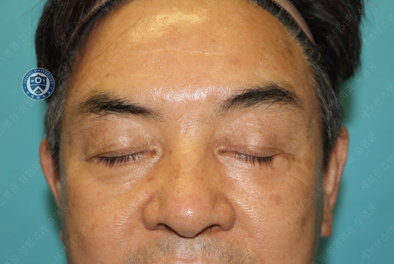 68세 남성, 하안검 성형술 및 안검외반 교정 증례(68/M Lower blepharoplasty & Ectropion correction with triamcinolone) 관련 이미지 17