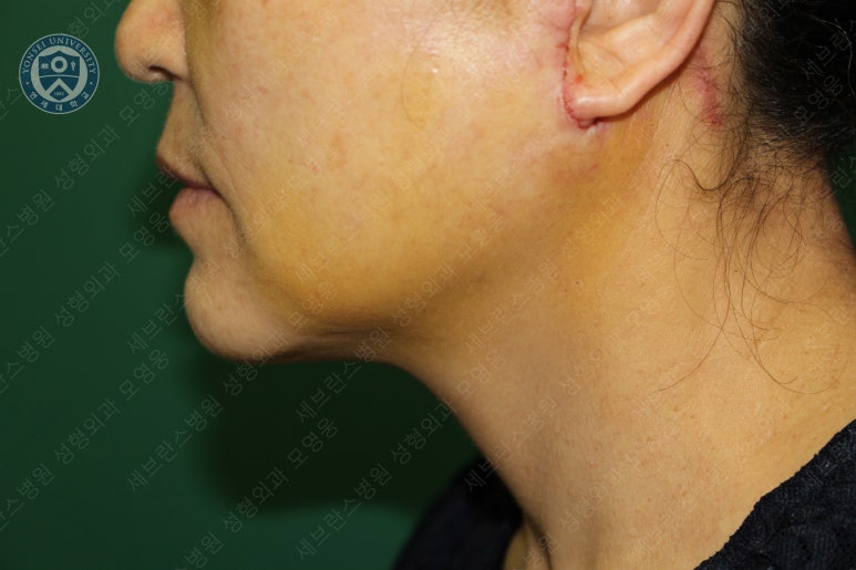 55세 여성, 이중평면 안면거상(55/F, Dual-plane full facelift) 관련 이미지 33