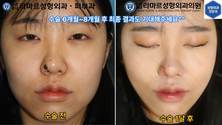 지름 1cm 코 점 제거수술 : 나선피판술(Spiral Flap) 수술전~1달 경과. (Feat. 턱끝필러+사각턱 보톡스) 관련 이미지 181