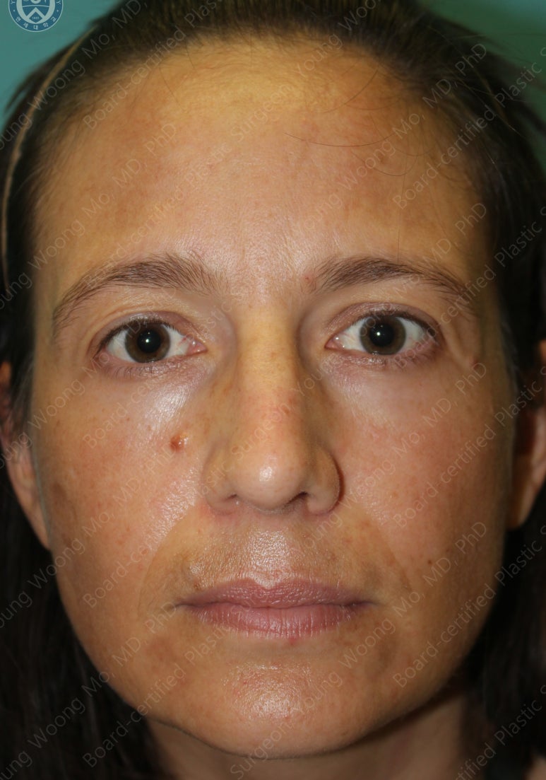 38세 서양 백인 여성, 쌍꺼풀 수술과 눈매교정 및 하안검성형술 (38/F Upper&lower blepharoplasty with levator plication) 관련 이미지 2