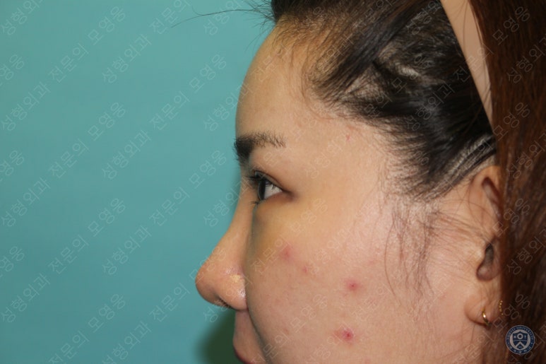28세 여성 두줄따기, 눈밑지(28/F D.E.O & transconjunctival septal fat redraping) 관련 이미지 14