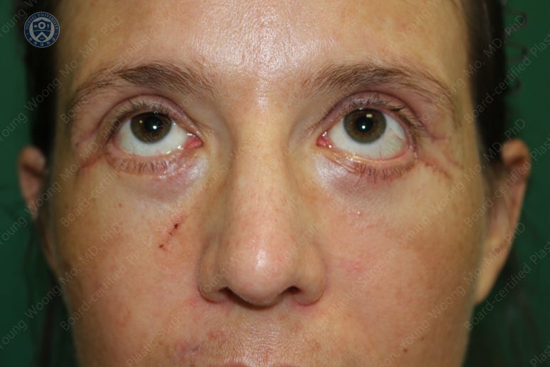 38세 서양 백인 여성, 쌍꺼풀 수술과 눈매교정 및 하안검성형술 (38/F Upper&lower blepharoplasty with levator plication) 관련 이미지 24