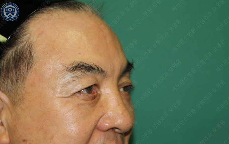 68세 남성, 하안검 성형술 및 안검외반 교정 증례(68/M Lower blepharoplasty & Ectropion correction with triamcinolone) 관련 이미지 11