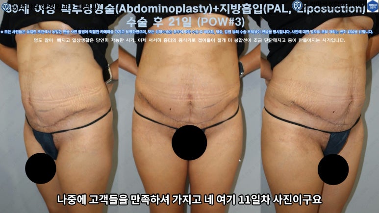 '복부성형술+지방흡입(Abdominoplasty+PAL)' 으로 뱃살 끝장내기! 관련 이미지 47