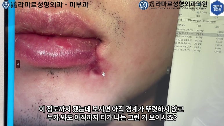 개에 물려 입술 1/3이 뜯긴 19세 남자분 치료 및 흉터 성형수술& 레이저 후기....! 관련 이미지 34