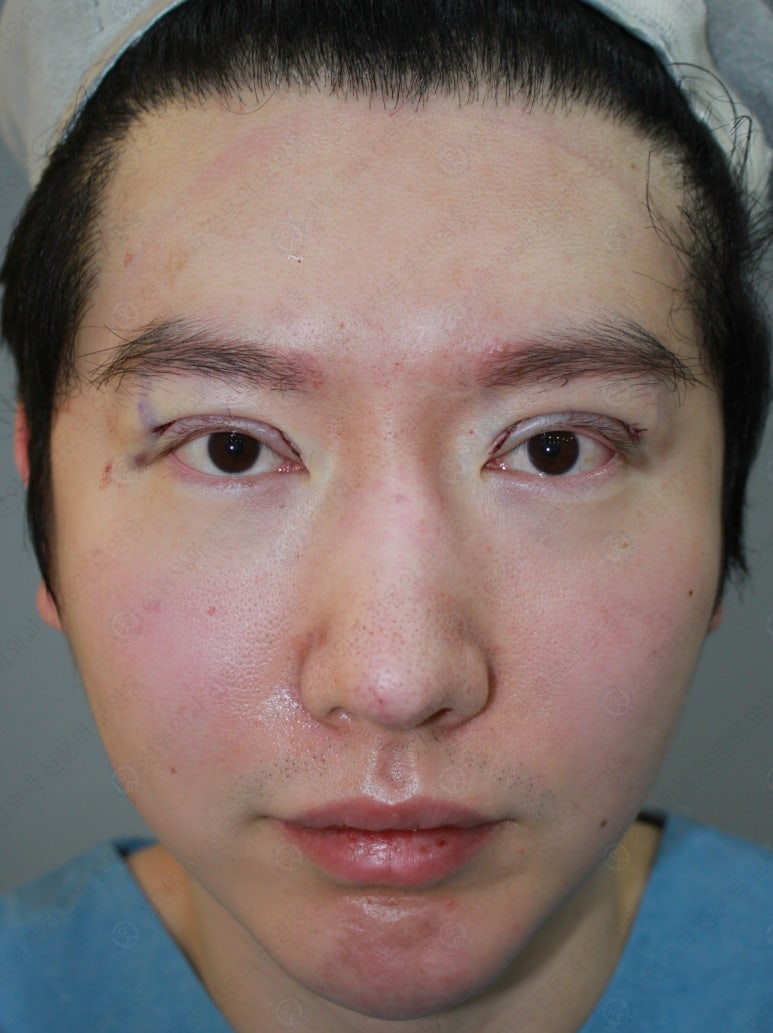 29세 남자, 소시지 쌍꺼풀 두줄따기로 낮추기 (쌍꺼풀 재수술) 관련 이미지 77