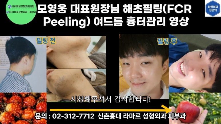 모영웅 대표원장 해초필링(FCR peeling) 피부관리영상...! 멍게피부가 사과피부가 되는 과정을 보여드립니다^^ 관련 이미지 42