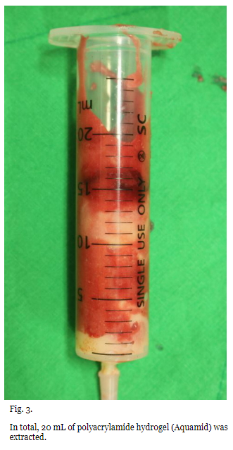 AAPS-Polyacrylamide hydrogel (Aquamid) filler removal after a decade 관련 이미지 5