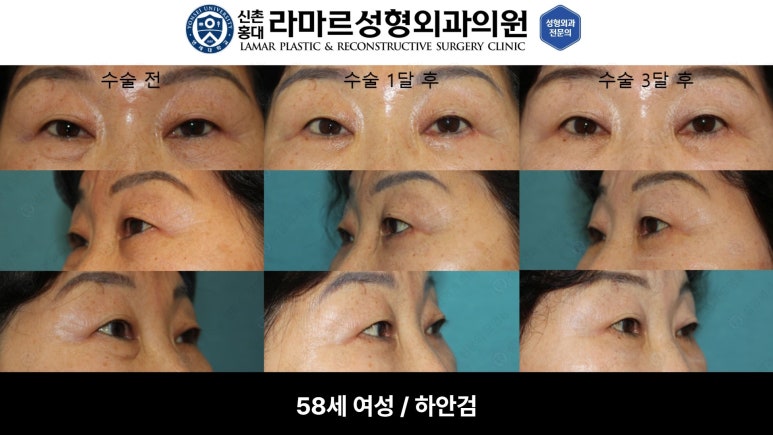 30대~80대 눈 수술 케이스 : 하안검성형술 전후 사진 모음 관련 이미지 15