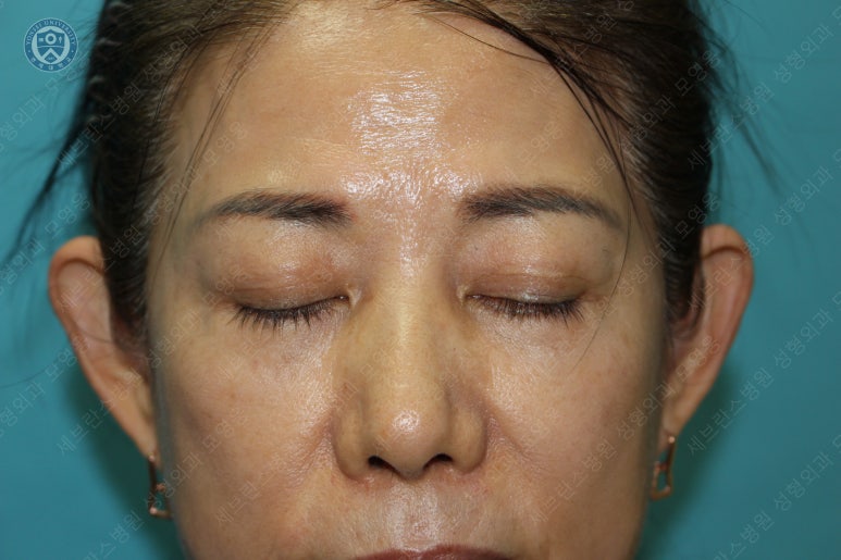 59세 여성, 그레이브스 안병증이 있는 돌출눈 중년 여성 하안검 성형술 (Lower blepharoplasty in Graves 관련 이미지 35