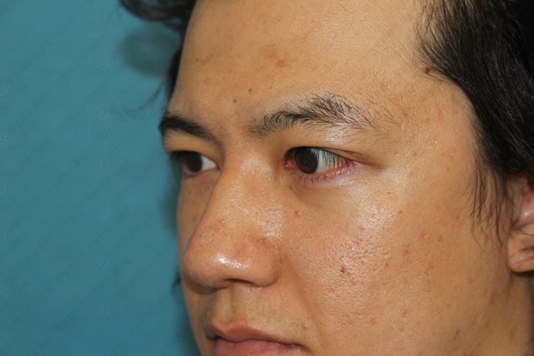 27세 남성 무쌍(속쌍)눈매교정 (27/M Ptosis correction with double lid plasty) 관련 이미지 26