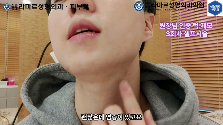 [성형외과 전문의의 셀프시술 제8편] 인중, 아래턱 제모 4회차 결과 공개! 관련 이미지 40