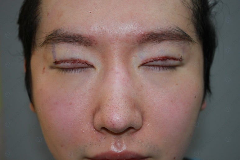 29세 남자, 소시지 쌍꺼풀 두줄따기로 낮추기 (쌍꺼풀 재수술) 관련 이미지 79