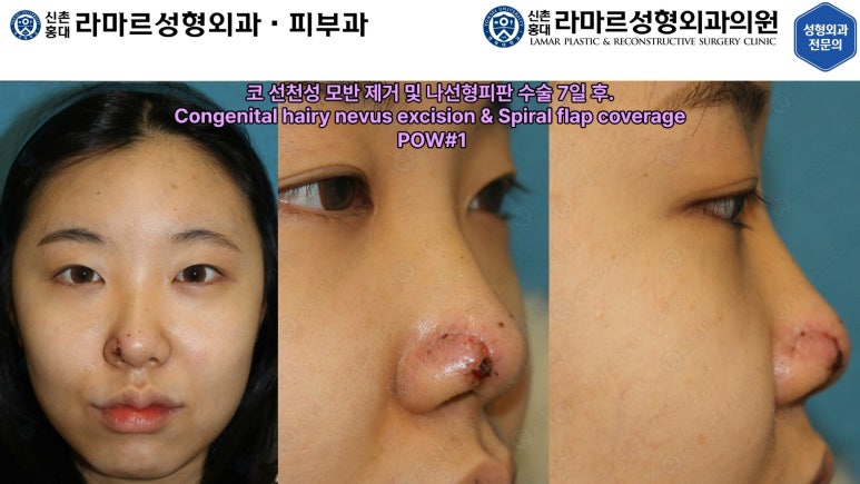 지름 1cm 코 점 제거수술 : 나선피판술(Spiral Flap) 수술전~1달 경과. (Feat. 턱끝필러+사각턱 보톡스) 관련 이미지 72