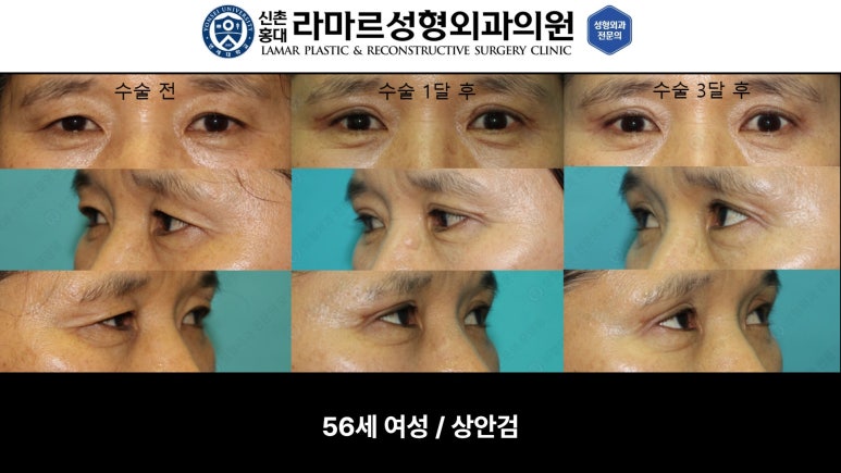 40대~80대 눈 수술 케이스 : 상안검성형술 전후 사진 모음 관련 이미지 21