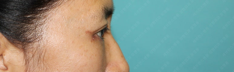 55세 여성, 상안검 및 하안검 성형술 증례 (55/F Upper & lower blepharoplasty) 관련 이미지 19