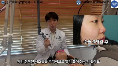 21세 여성 코 지름 1cm 점 제거수술 : 나선피판술(Spiral Flap) 수술전~5달 경과. (+쌍꺼풀수술, 코필러) 관련 이미지 41