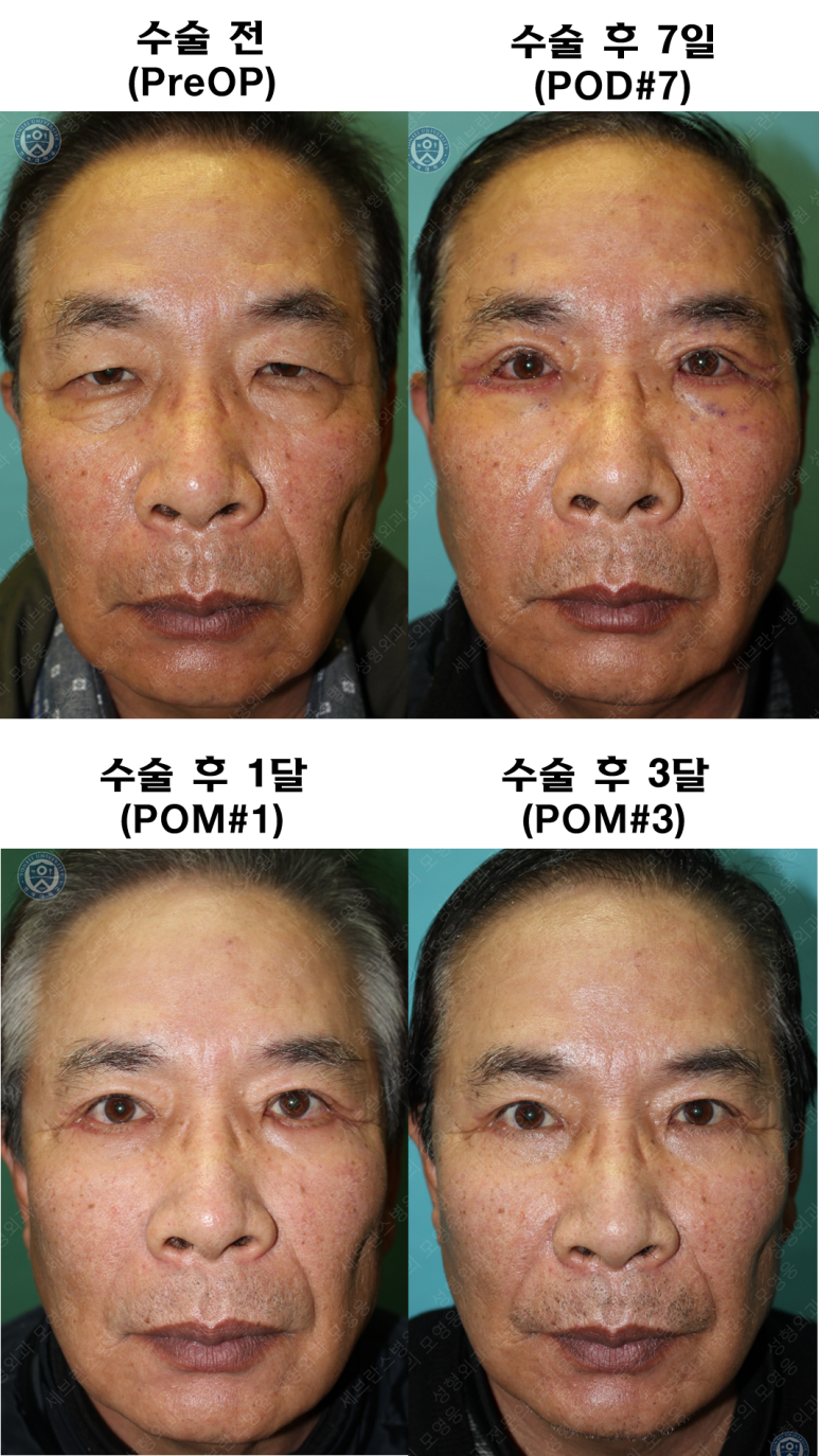 67세 남성, 상&middot;하안검성형술 및 안검하수교정 (67/M, Upper &  lower blepharoplasty with ptosis correction) 관련 이미지 47