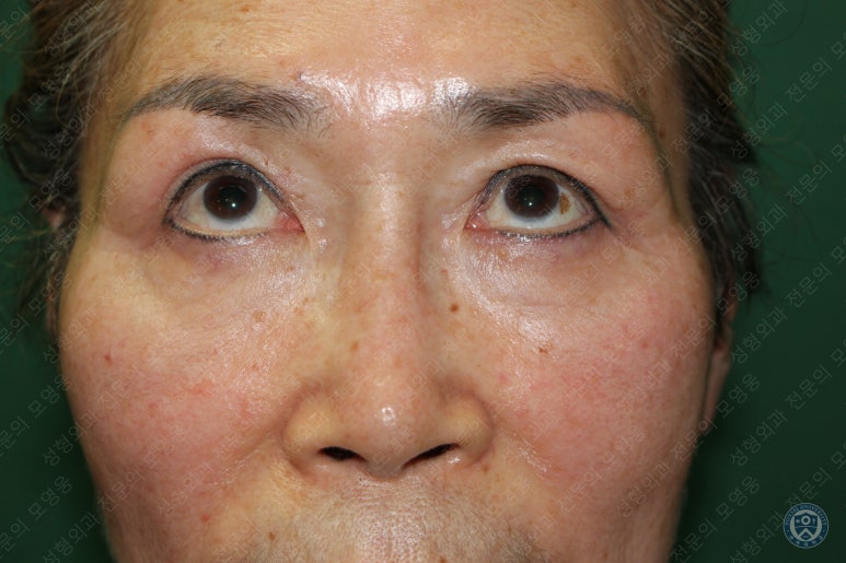 64세 여성 상안검성형술+눈매교정 (64/F Upper blepharoplasty with ptosis correction) 관련 이미지 37