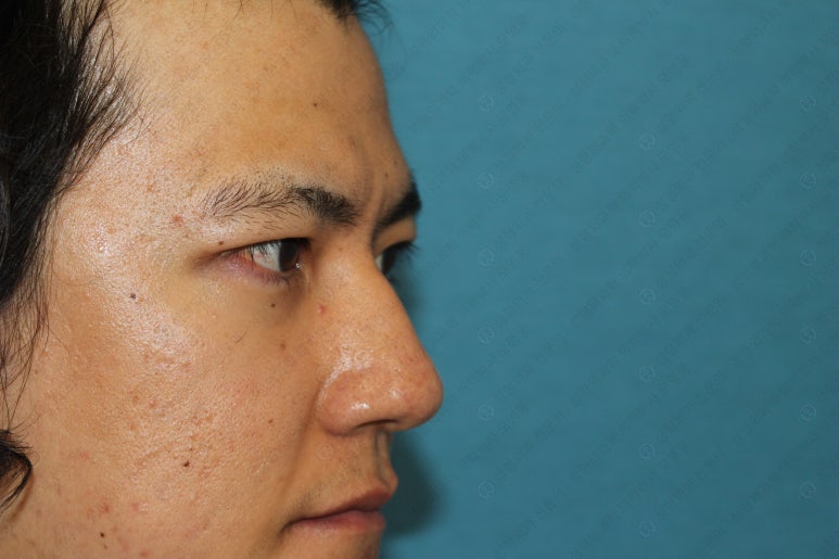 27세 남성 무쌍(속쌍)눈매교정 (27/M Ptosis correction with double lid plasty) 관련 이미지 27