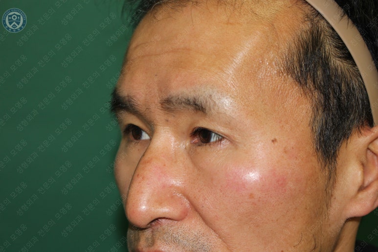 남자눈성형: 무쌍눈매교정 (Blephroptosis correction-levator aponeurosis advancement) 관련 이미지 41