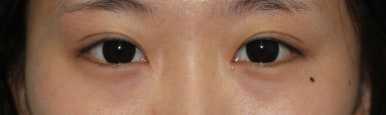 17세 여성, 쌍꺼풀+앞트임(DEO+Medial epicanthoplasty) 관련 이미지 30