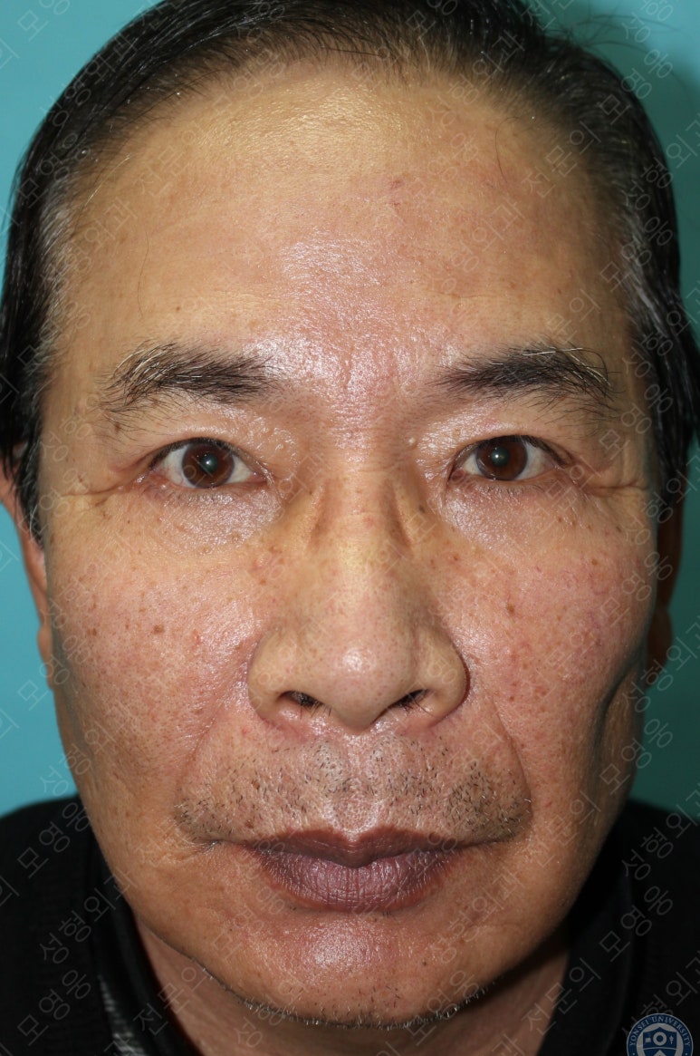 67세 남성, 상&middot;하안검성형술 및 안검하수교정 (67/M, Upper &  lower blepharoplasty with ptosis correction) 관련 이미지 36