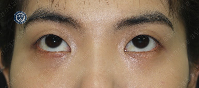 28세 여성, 눈밑지방재배치(눈밑지, 28/F Transconjunctival septal fat redraping-internal fixation technique) 관련 이미지 25
