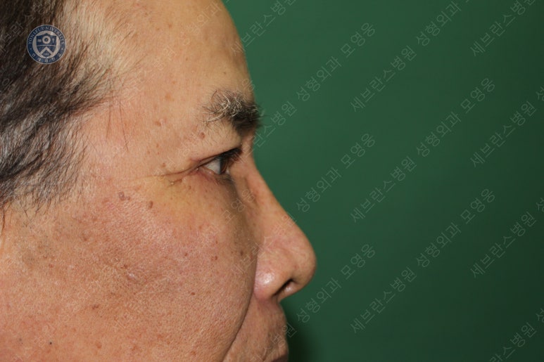 67세 남성, 상&middot;하안검성형술 및 안검하수교정 (67/M, Upper &  lower blepharoplasty with ptosis correction) 관련 이미지 35