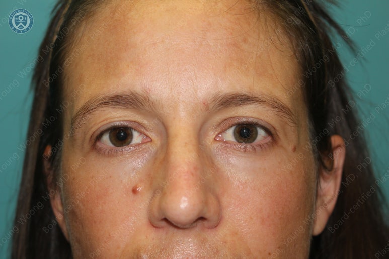 38세 서양 백인 여성, 쌍꺼풀 수술과 눈매교정 및 하안검성형술 (38/F Upper&lower blepharoplasty with levator plication) 관련 이미지 3