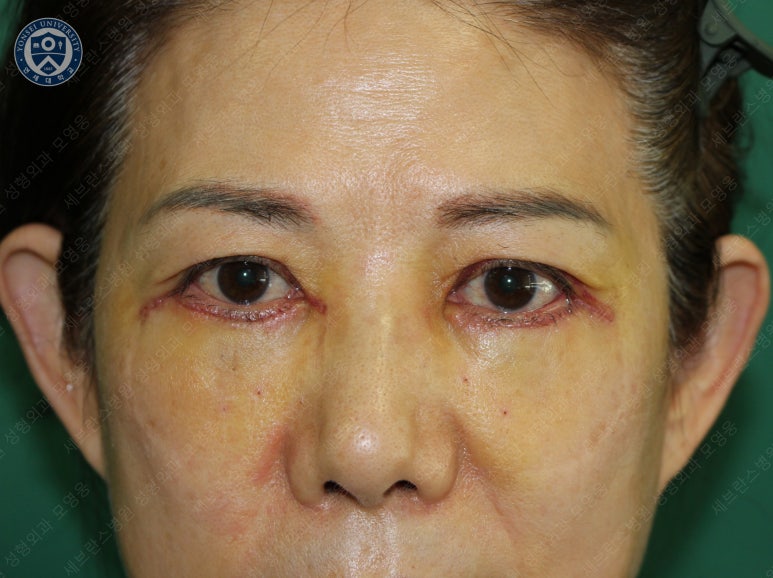 59세 여성, 그레이브스 안병증이 있는 돌출눈 중년 여성 하안검 성형술 (Lower blepharoplasty in Graves 관련 이미지 10