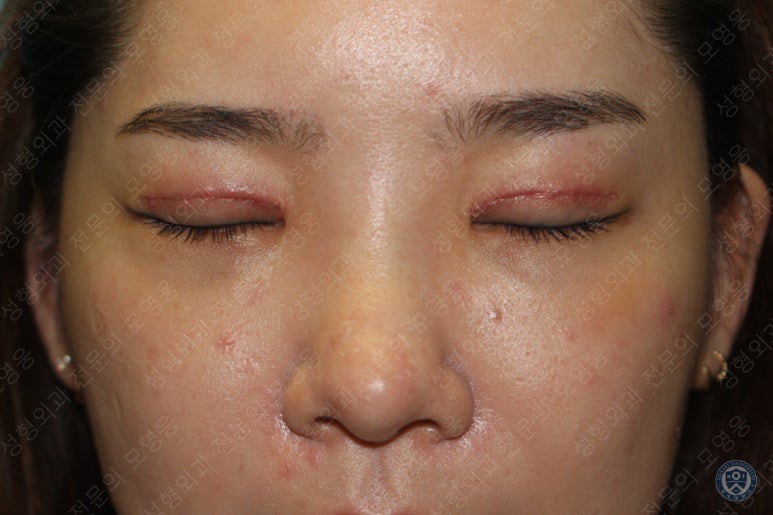 28세 여성 두줄따기, 눈밑지(28/F D.E.O & transconjunctival septal fat redraping) 관련 이미지 12
