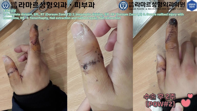 손가락 힘줄 손상 및 열상, 손톱 바닥 열상 처치 (Extensor tendon repair and nailbed injury treatment) 관련 이미지 39
