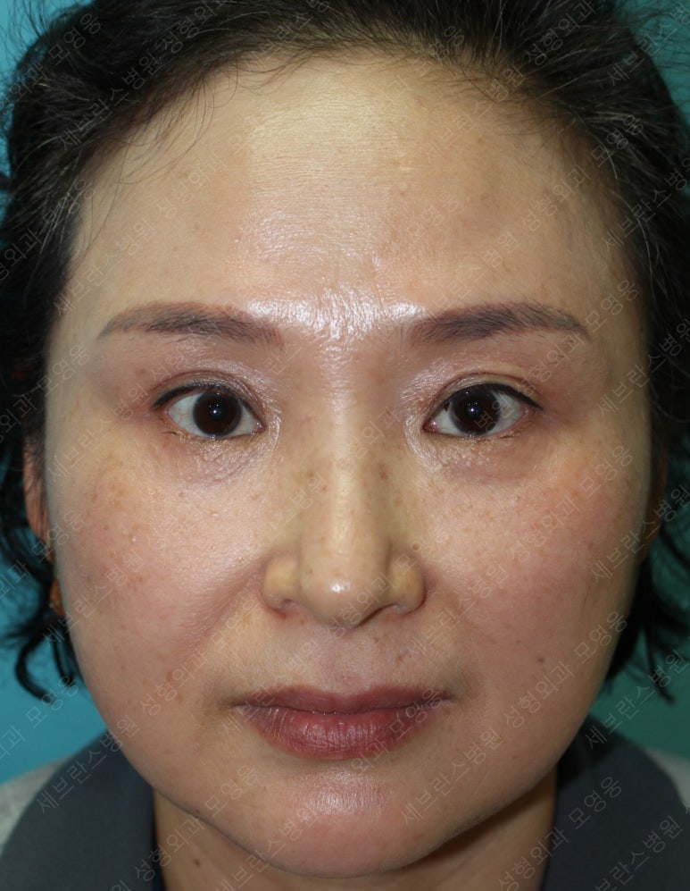 49세 여성, 토안이 있는 중년여성의 상안검성형술 (49/F, Upper blepharoplasty with lagophthalmos correction& LP) 관련 이미지 32