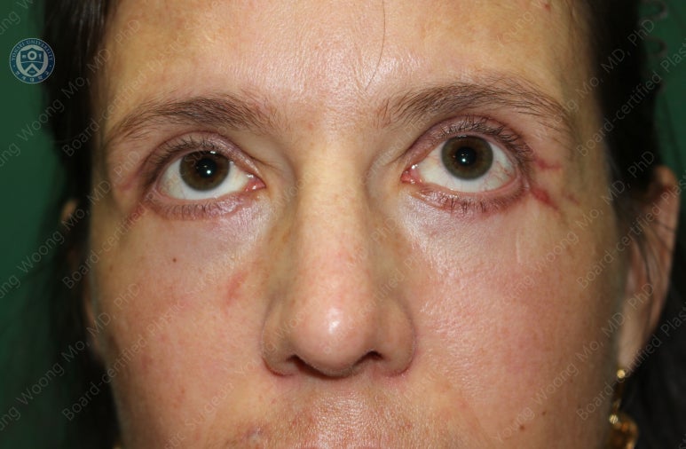 38세 서양 백인 여성, 쌍꺼풀 수술과 눈매교정 및 하안검성형술 (38/F Upper&lower blepharoplasty with levator plication) 관련 이미지 32